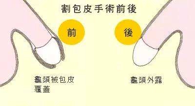 割包皮一般多少钱啊,关于割包皮手术费用及创新方案解析的文章,创新策略推广_set42.34.60