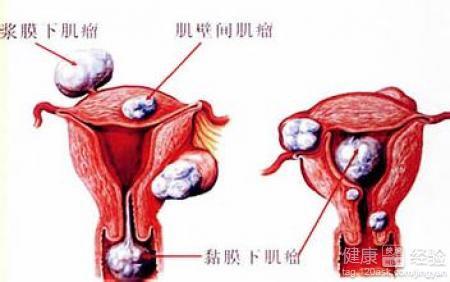 子宫肌瘤10大禁忌食物!