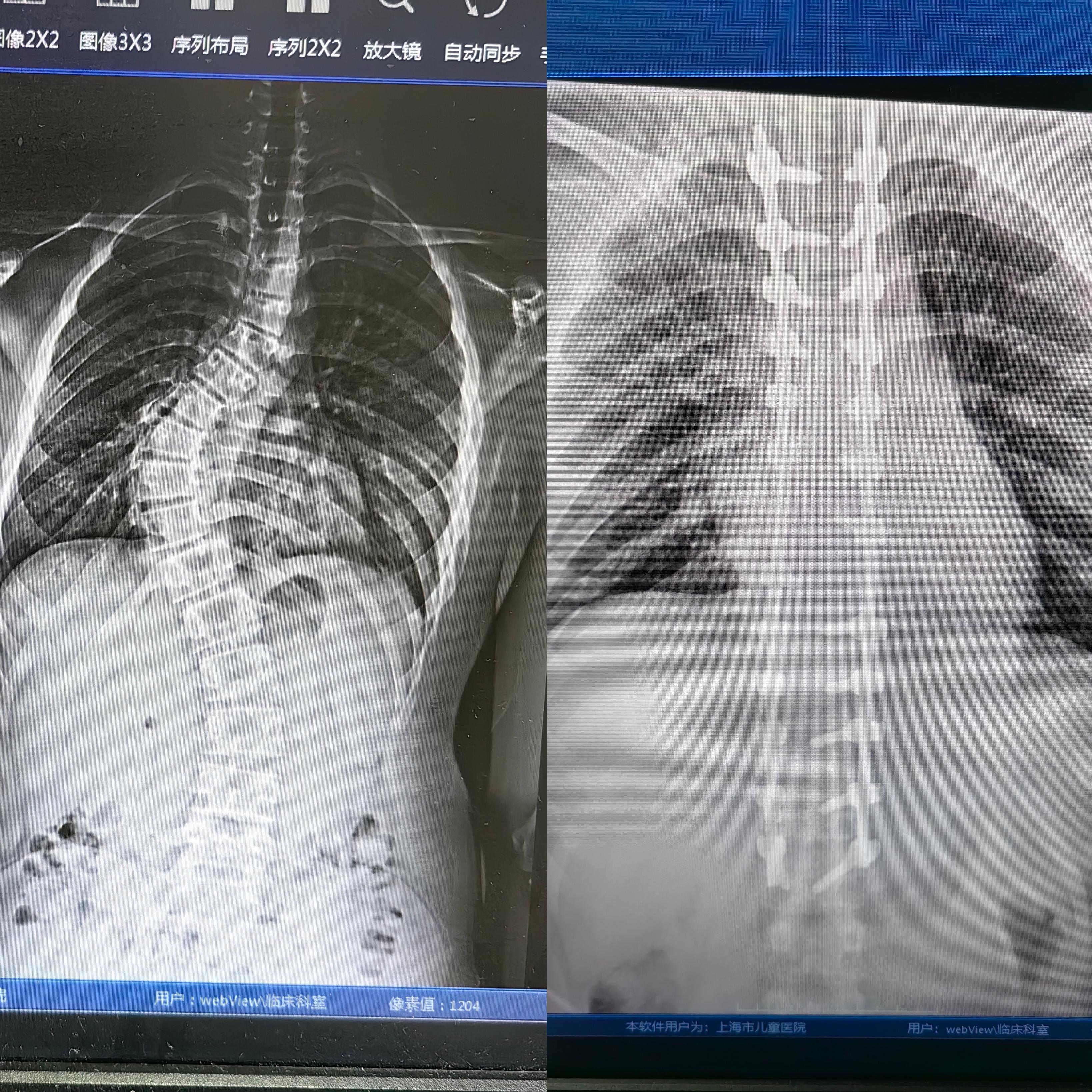 孩子脊柱健康检查